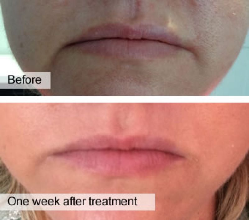 Before and after Correction of downward turning & asymmetry of corners of mouth with dermal fillers